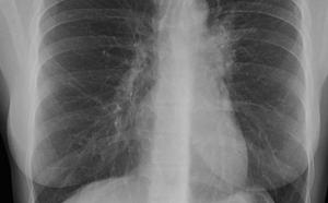 Tuberculoza, TBC este o boala vindecabila, medicale, pneumoftiziologie