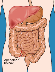 Apendicectomia - inlaturarea chirurgicala a apendicelui vermiform