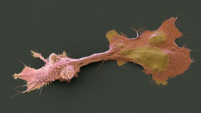 Cum acționează sistemul anti-cancer din celule umane, descoperit de cercetători israelieni | Digi24